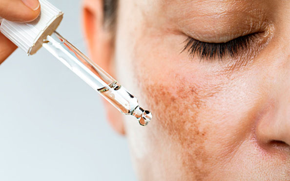 Melasma